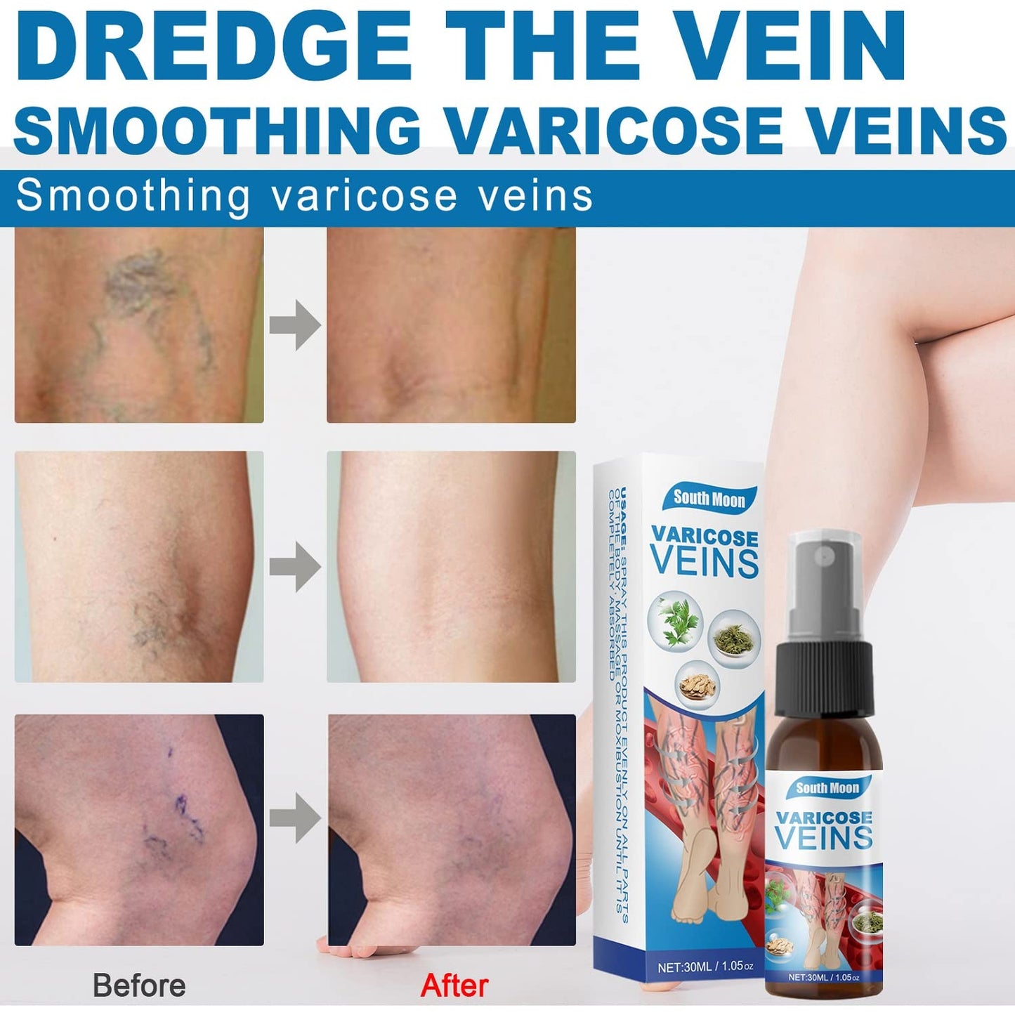 Spray natural para venas varicosas, 30 ml. SUPER OFERTA 2x1, tratamiento para venas varicosas en piernas, mejora la circulación en las piernas.
