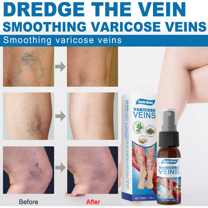 Spray natural para venas varicosas, 30 ml. SUPER OFERTA 2x1, tratamiento para venas varicosas en piernas, mejora la circulación en las piernas.